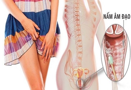 Cách chữa trị và phòng ngừa viêm âm đạo
