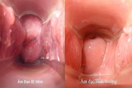 Viêm âm đạo là gì? Các dấu hiệu nhận biết đơn giản