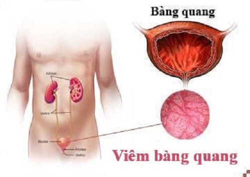 Viêm bàng quang ở nữ, nam