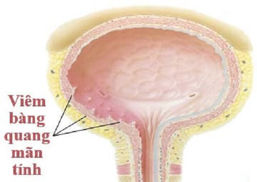 Viêm bàng quang mãn tính