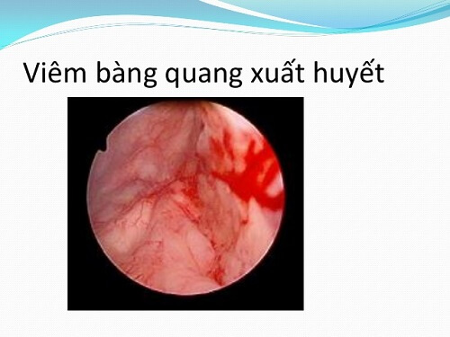 Viêm bàng quang xuất huyết