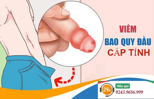Viêm bao quy đầu cấp tính
