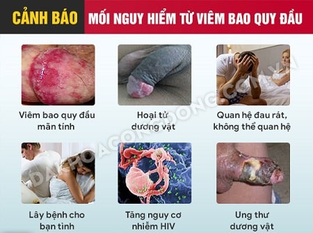 Viêm bao quy đầu mãn tính có nguy hiểm không ?