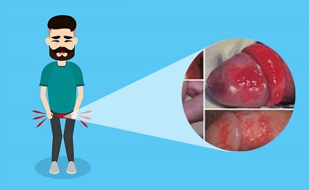 Tìm hiểu viêm bao quy đầu mãn tính là gì ?