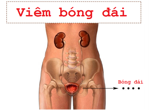 Viêm bóng đái