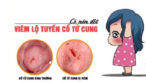 Viêm lộ tuyến cổ tử cung có nên đốt không?