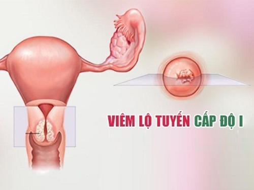 Viêm lộ tuyến cổ tử cung cấp độ 1