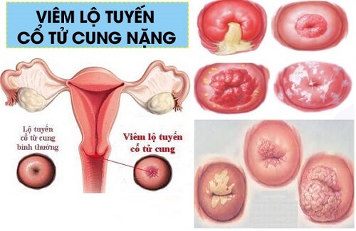 Hình ảnh viêm lộ tuyến cổ tử cung nặng