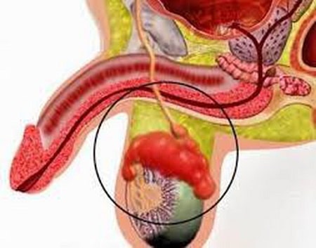 Dấu hiệu nhận biết viêm mào tinh hoàn trái