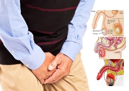 Phương pháp điều trị viêm mào tinh hoàn trái hiệu quả