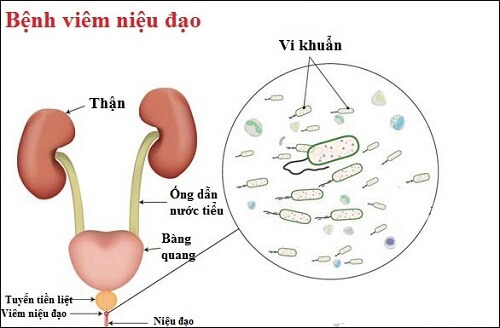 Viêm niệu đạo