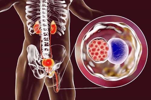 Viêm niệu đạo không lậu