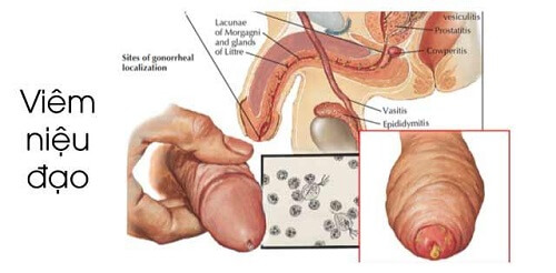 Hình ảnh viêm niệu đạo ở nam giới
