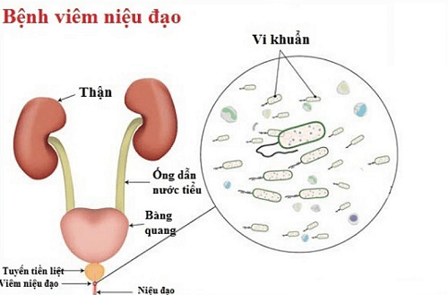 Viêm niệu đạo ở nam và nữ