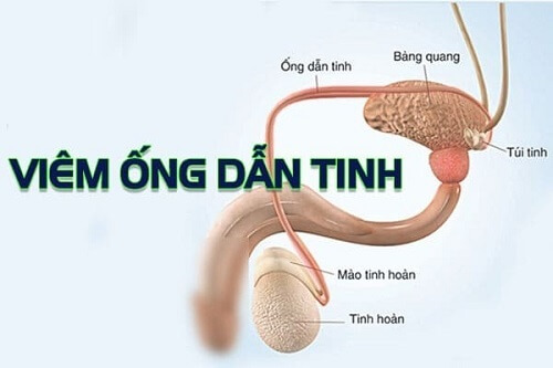 Viêm ống dẫn tinh 