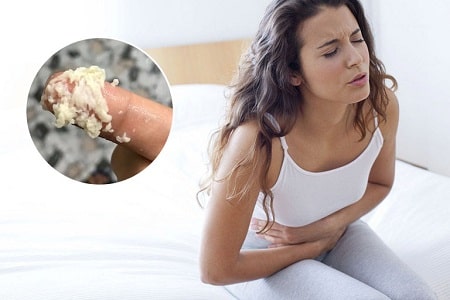 Khí hư bã đậu ở vùng kín - Một số nguyên nhân khác 