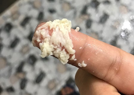 Viêm phụ khoa bã đậu có nguy hiểm không ?