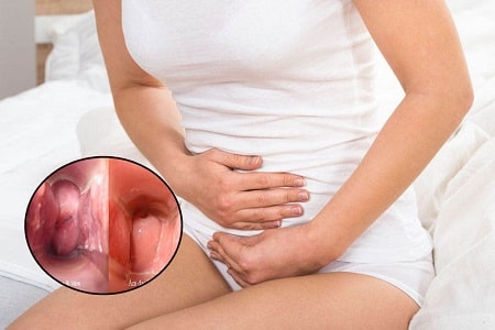 Viêm phụ khoa bị ngứa có nguy hiểm không? 