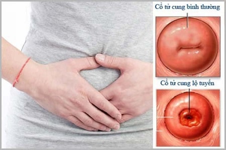 Biến chứng nguy hiểm của viêm phụ khoa độ 2