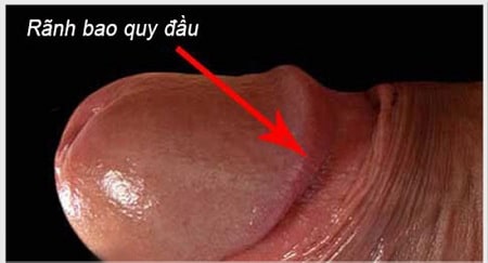 Viêm rãnh bao quy đầu là gì ?