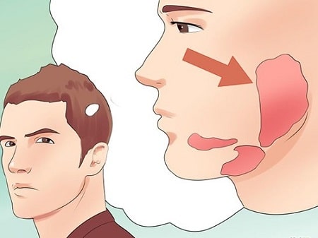 Chuyên gia giải đáp viêm tinh hoàn sau quai bị có vô sinh không? 