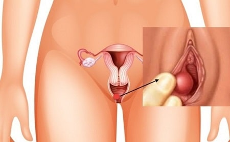 Viêm tuyến bartholin là gì ?