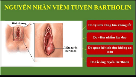 Nguyên nhân thường hay mắc viêm tuyến Bartholin