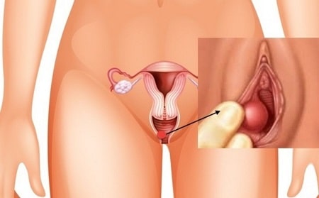 Nguyên nhân gây viêm tuyến Bartholin sưng to do đâu?