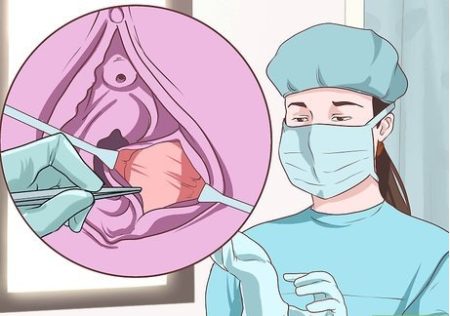 Biện pháp xử lý tình trạng viêm tuyến bartholin tái phát