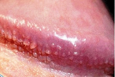 Vùng kín có chấm trắng – Biểu hiện bệnh sùi mào gà