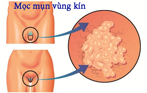 Bị nổi mụn dưới vùng kín nam, nữ 
