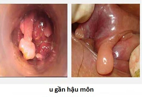 Xuất hiện khối u gần hậu môn là bị bệnh gì?